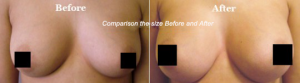 Breasts before and after the use of Triactol with Mirofirm