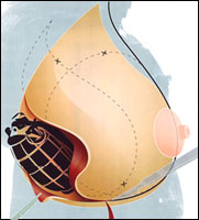 breast implant